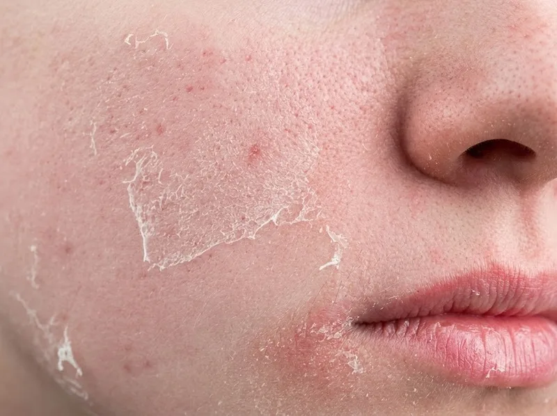 Da có thể bong nhẹ sau peel nhưng cần theo dõi các dấu hiệu bất thường